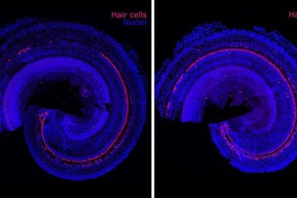 فناوری جدید برای درمان کم شنوایی