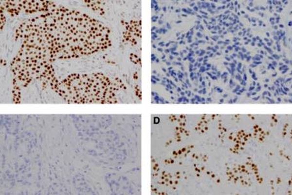 کشف یک مکانیسم پروتئینی برای درمان سرطان بدقلق سینه