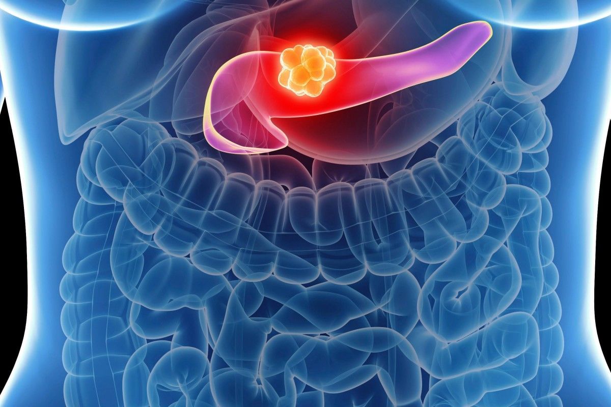 مرگ خاموش با پانکراس | علائم سرطان پانکراس 
