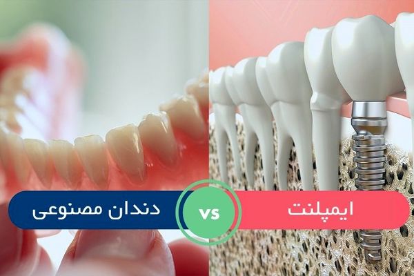 فرق ایمپلنت و دندان مصنوعی