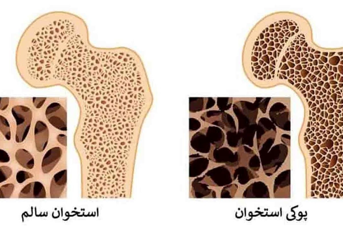 راه‌های فرار از پوکی استخوان