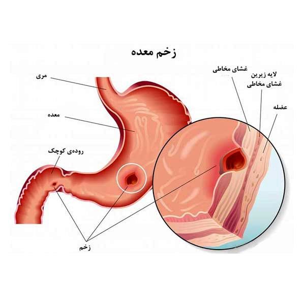 روزه داری برای افراد با زخم معده توصیه نمیشود | باید ها و نباید های روزه داری با زخم معده