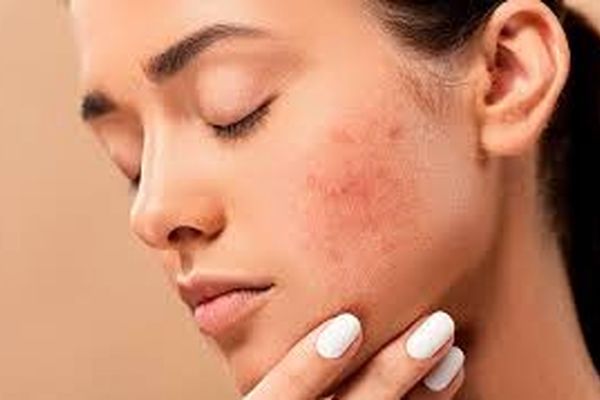 علت بوجود آمدن جوش های زیر پوستی و راه حل ریشه کن کردن آنها.