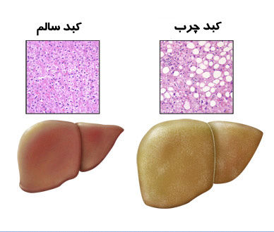 موادغذایی مفید برای کاهش کبد چرب از منظر طب سنتی