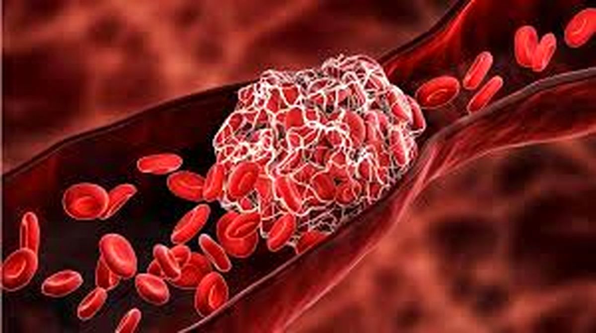 این دردها نشانگر لخته شدن خون در بدن است | دردها را جدی بگیرید