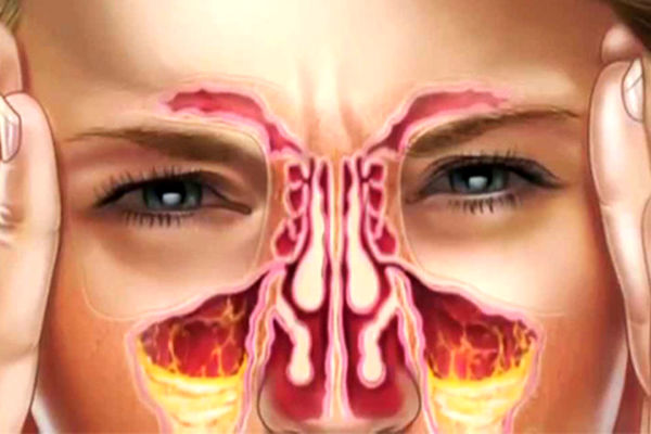 تشخیص بیماری از روی خلط | رنگ خلط نشان دهنده چه نوع بیماری هایی است ؟