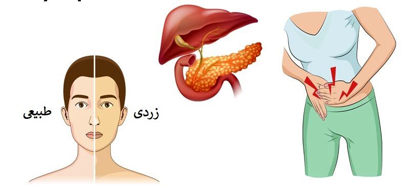 تشخیص سریع سرطان لوزالمعده | از چه زمانی میتوان سرطان لوزالمعده را تشخیص داد 