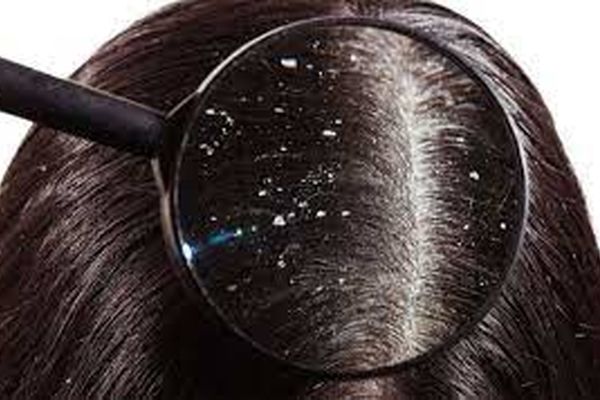 چرا سرم شوره زده و درمان نمیشه؟ | روش درمان آسان و سریع شوره سر