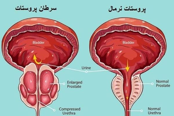 بهترین روش برای جلوگیری از سرطان پروستات | برای جلوگیری از ابتلا به سرطان پروستات این کار مهم را انجام دهید
