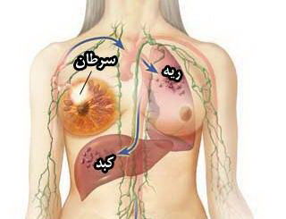 سرطان پستان|خود آزمایی و تشخیص زود هنگام سرطان پستان