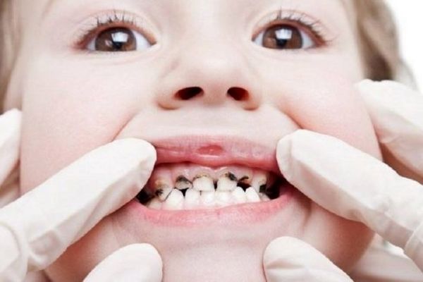 با چند کار ساده از دندانپزشکی خداحافظی کنید| چند راهکار جلوگیری از پوسیدگی دندان