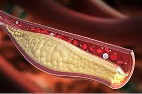 پایین آوردن چربی خون با این خوراکی  | راه های پایین آوردن چربی خون با گل کلم 