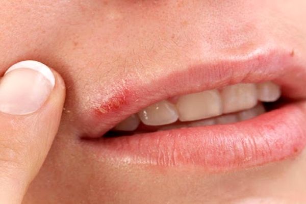 برای رفع خشکی لب چه کنیم؟ | روش رفع خشکی لب