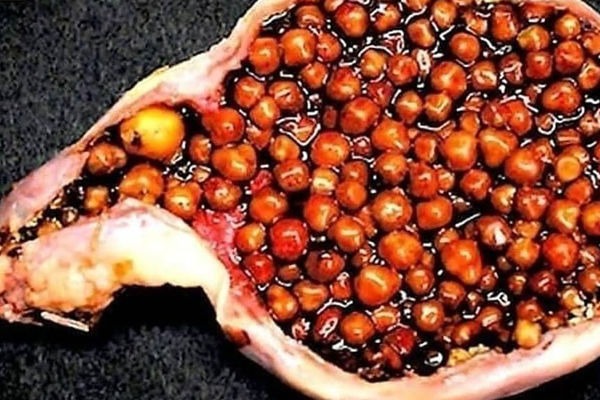 درمان سنگ کیسه صفرا در ۴۰ روز | دلایل سنگ کیسه صفرا +ویدیو 