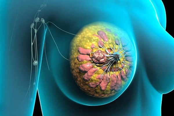 با خوردن این خوراکی ها سرطان سینه دور بزنید !