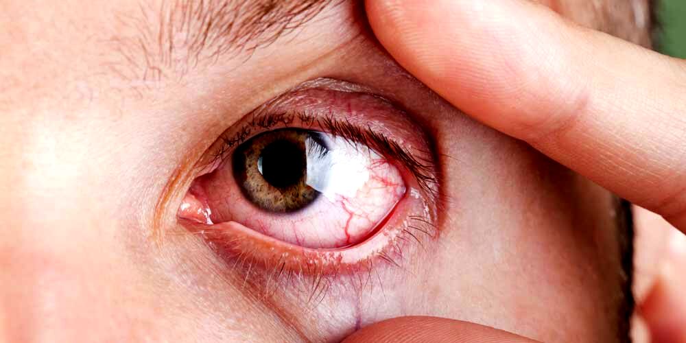با خشکی چشم خداحافظی کن | درمان خانگی خشکی چشم 