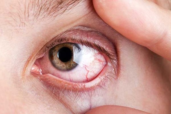 راهکار جلوگیری از ضعیفی بیشتر چشم | این کارها را انجام نده+ ویدیو