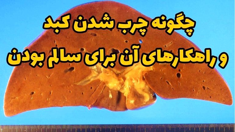 چگونه چرب شدن کبد و راهکار های آن برای سالم بودن