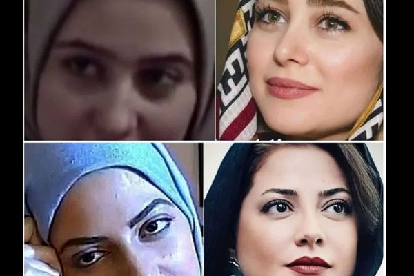 تغییر قیافه عجیب بازیگران | بازیگرانی که با عمل جراحی خود را از نو ساختند 