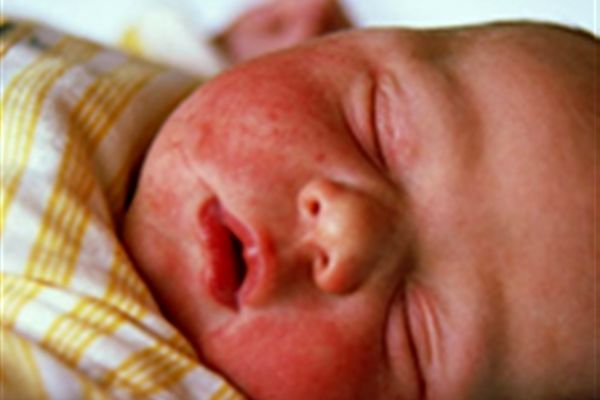 کمبود ویتامین D و ارتباط آن با اگزما | خطر ابتلا به اگزما در کودکانی که ویتامین D آن ها کم است