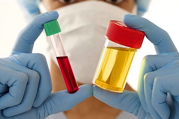 این رنگ ادرار خطرناک است | این رنگ ادرار نشانه یک بیماری خطرناک است ؟ 