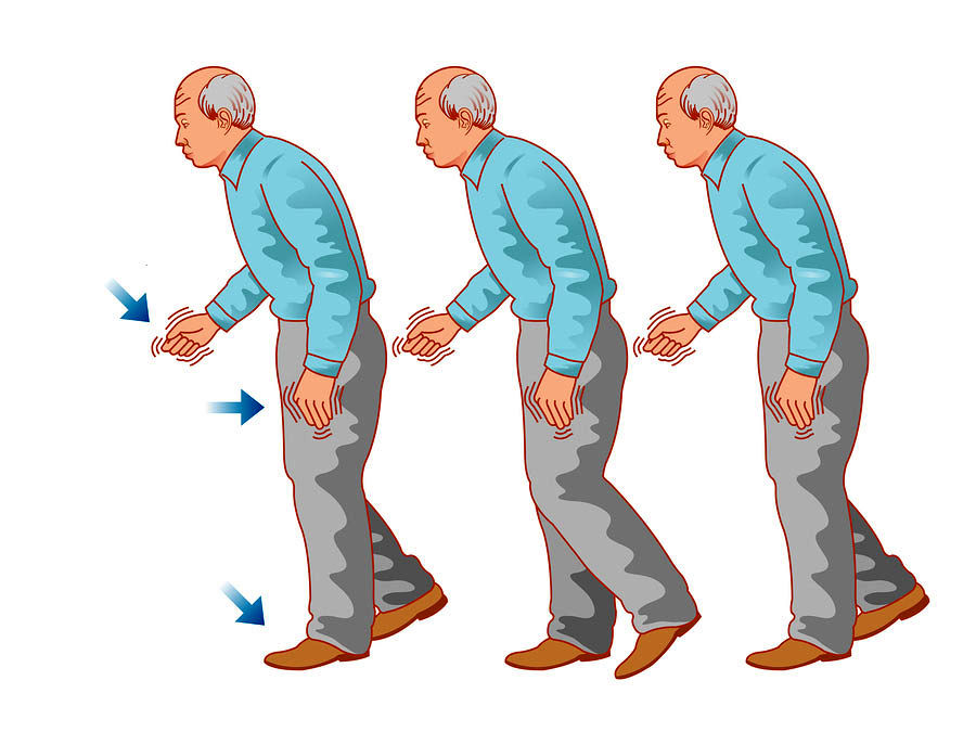 از بیماری پارکینسون چه میدانید | اولین علائمش چه چیزی است 