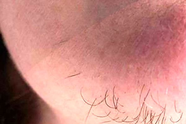 علت موهای زائد خانم ها چیست | راه حل رفع موی زائد خانم ها