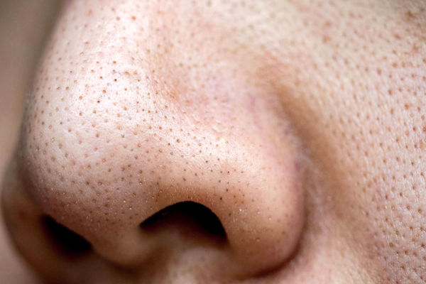 با دو قلم مواد جوش های سر سیاه را در خانه از بین ببر | ترفند خداحافظی با جوش سر سیاه