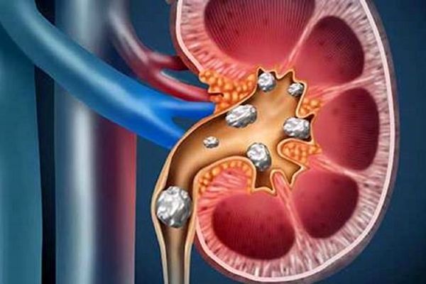 سنگ شکنی کلیه با فناوری جدید