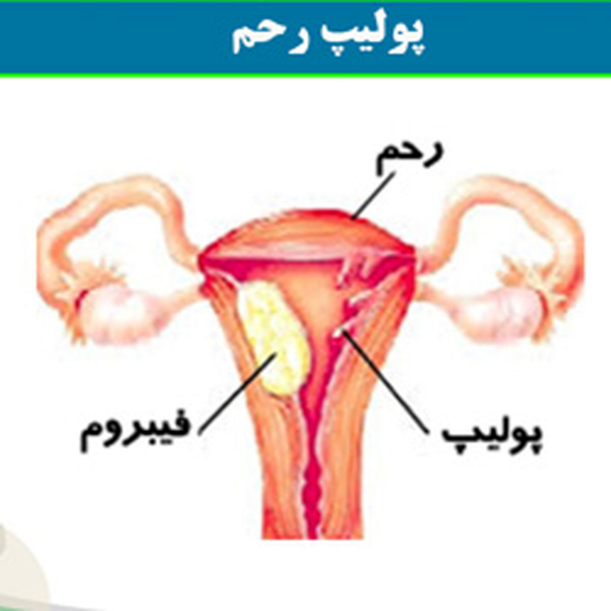 نشانه سرطان رحم در زنان | نشانه های اولیه سرطان رحم | خانم ها مراقب باشند 