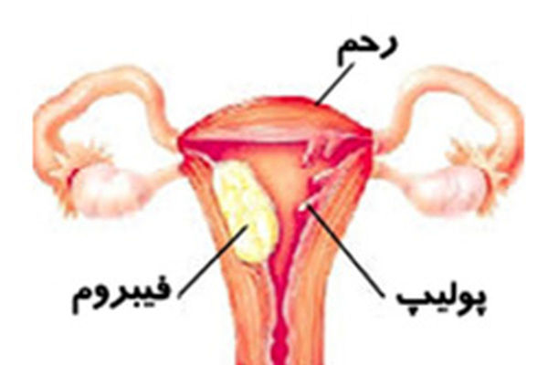 نشانه سرطان رحم در زنان | نشانه های اولیه سرطان رحم | خانم ها مراقب باشند 