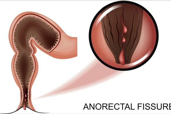 شقاق چیست + معرفی 6 روش درمانی