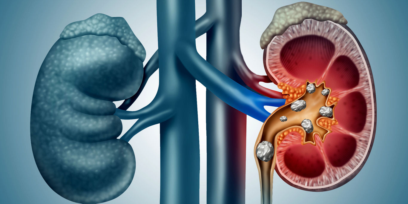 سنگ شکنی کلیه با فناوری جدید
