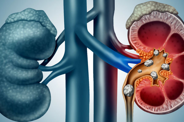 سنگ شکنی کلیه با فناوری جدید